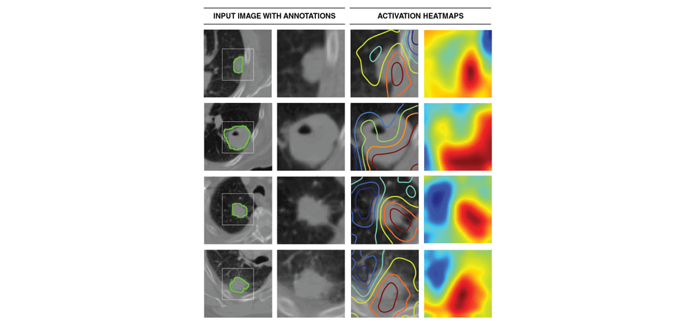 deep-learning-lung-cancer-prognostication-retrospective-multi-cohort-radiomics-study-5